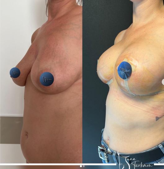 breast-lift-with-implant